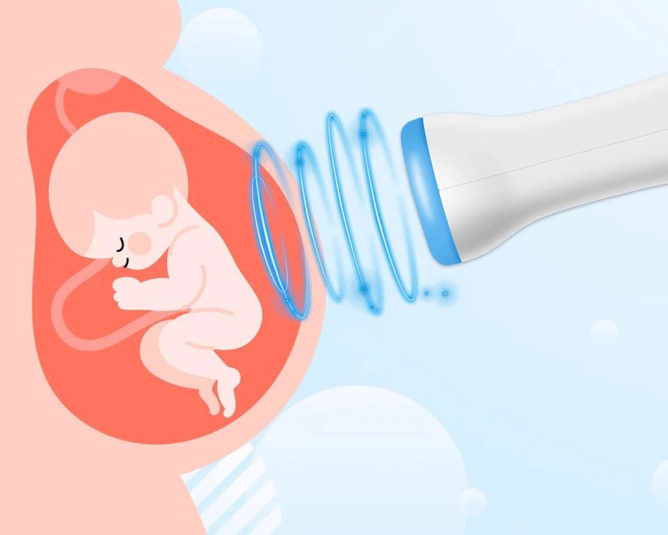 FETÁLNY DOPPLER (BABY WATCHER) DOMÁCI ULTRAZVUK PRED TEHOTNÝMI ZENY
